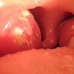 Definición de medicina de: Mononucleosis infecciosa Definición de medicina de: Mononucleosis infecciosa